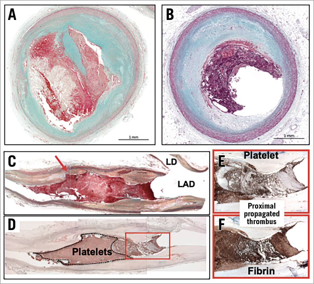 Figure 1. The pathology of plaque rupture and plaque erosion. A) Plaque rupture and (B) erosion histologic sections. Plaque ruptures tend to show more severe luminal stenosis (90% cross-sectional area stenosis), while plaque erosion has less severe narrowing (60% area stenosis). C) Longitudinal section of a left anterior descending artery (LAD) with plaque rupture. The red arrow shows the site of rupture with overlying white thrombus predominantly composed of platelets. Note the proximal thrombus is a propagated red thrombus and shows layered thrombus rich in fibrin and red cells (D-F). A) – C) Movat pentachrome stain, (D) CD61, (F) Fibrin II. Panels C and D are reproduced with permission from Alfonso F and Virmani R9.