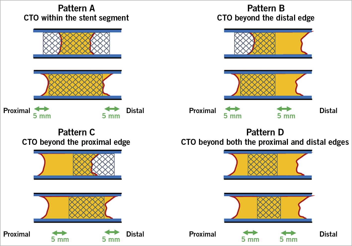 Central illustration. Occlusion patterns of in-stent chronic total occlusions. According to the occlusion patterns, in-stent CTOs were divided into the following groups. A) CTO within the stent segment. B) CTO beyond the distal edge. C) CTO beyond the proximal edge. D) CTO beyond both the proximal and distal edges. An edge was defined as an area 5 mm from the stent edge. The stent segment included the in-stent region as well as the proximal and distal edges. An edge was defined as an area 5 mm from the stent edge. The stent segment included the in-stent region, as well as the proximal and distal edges. The selection of the CTO-PCI strategy was at the operator’s discretion. In each occlusion pattern, the procedural strategies were classified into an antegrade approach alone, rescue bidirectional approach, and primary bidirectional approach. The procedural strategy, guidewire success, technical success, procedural success, procedural time, contrast volume, fluoroscopic time, in-hospital major adverse cardiac and cerebrovascular events (MACCE), and other complications were compared among the four occlusion patterns. The guidewire crossing time was also compared to the guidewire success.