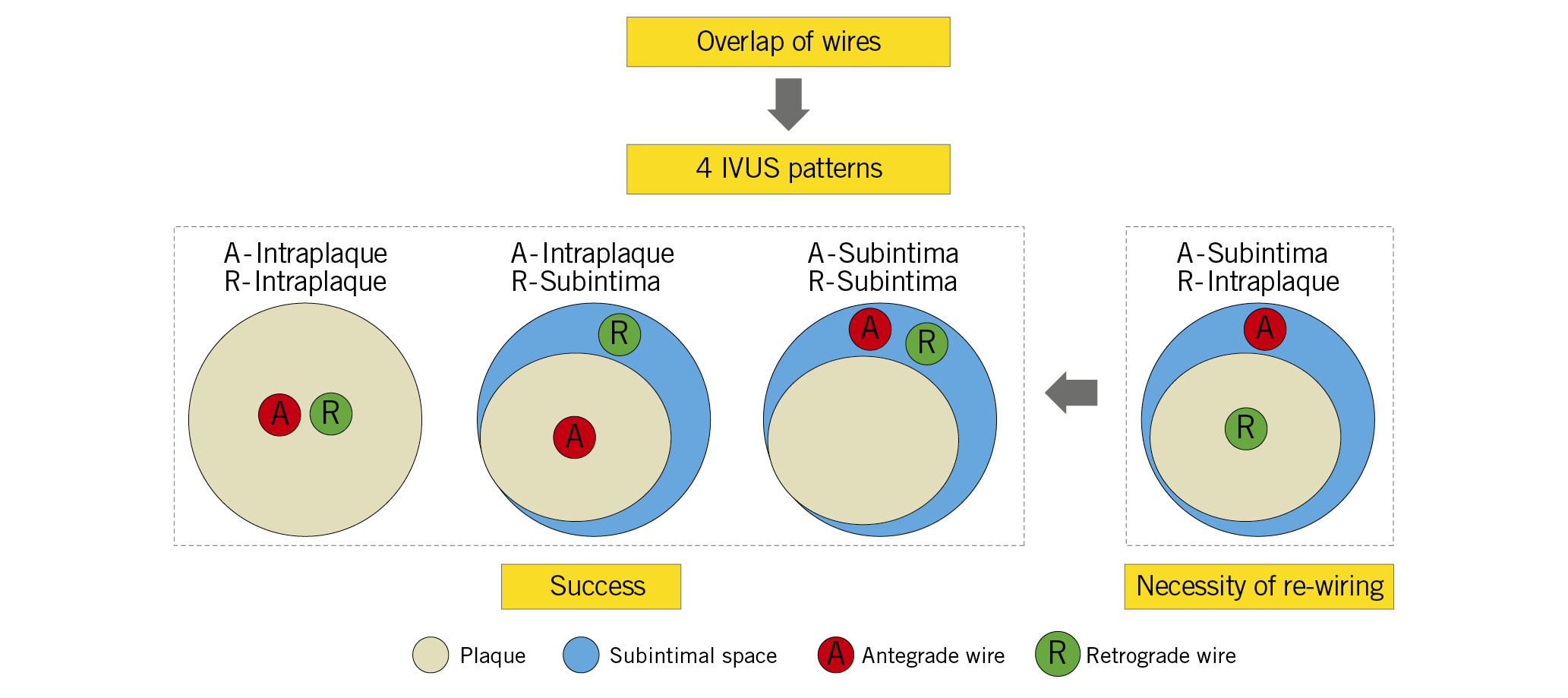 Visual summary. When the antegrade wire is in the subintimal space and the retrograde wire is in the intraplaque, re-wiring is almost always necessary.
