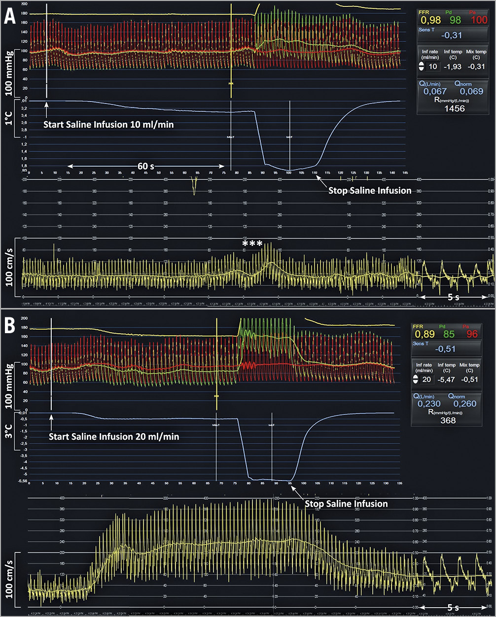 Figure 1. Example of simultaneous tracings of phasic and mean central aortic pressure, distal coronary pressure, average peak velocity and thermodilution during the infusion of 10 mL/min and of 20 mL/min of saline in the LAD of a 77-year-old male patient with mild wall irregularities. A) After the start and during the next 70 s of the infusion of saline at 10 mL/min through the RayFlow catheter located in the proximal LAD, no changes in distal coronary pressure, in Pd/Pa, or in APV were observed (reflecting a resting state). The slight oscillations in flow velocities (***) are caused by the pullback of the pressure/temperature wire. B) In contrast, after the start and during the next 70 s of the infusion of saline at 20 mL/min through the RayFlow catheter located in the proximal LAD, a decrease in Pd, a decrease in Pd/Pa, and an increase in APV were observed. After cessation of the intracoronary saline infusion, these indices returned to their baseline level. On the right-hand side, the CoroFlow software displays instantaneously all relevant parameters, including infusion rate, flow and resistance. APV: average peak velocity; LAD: left anterior descending coronary artery; Pa: aortic pressure; Pd: distal coronary pressure